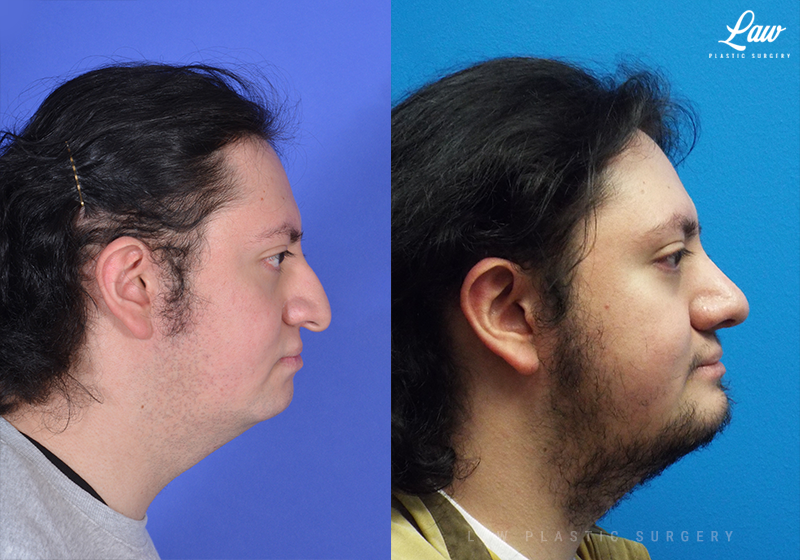 Chin Surgery Genioplasty Before After Photos Sage Plastic Surgery