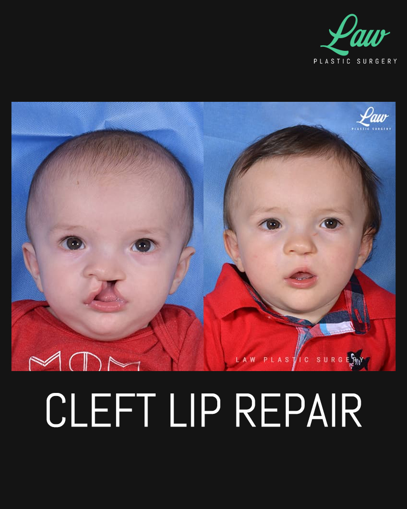 Cleft Lip Surgery Dallas Cleft Lip Repair Specialist Dallas TX Law