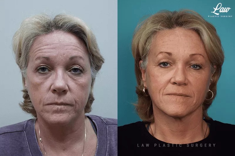 Brow Lift Before & After Photo. Surgery performed in Dallas, TX at Law Plastic Surgery.