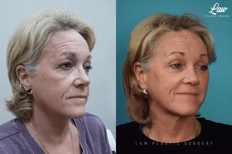 Brow Lift Before & After Photo. Surgery performed in Dallas, TX at Law Plastic Surgery.