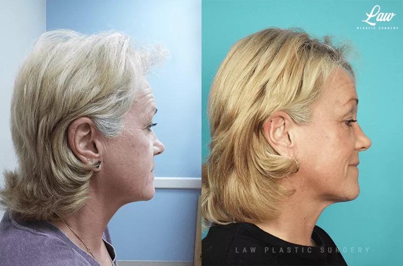 Brow Lift Before & After Photo. Surgery performed in Dallas, TX at Law Plastic Surgery.