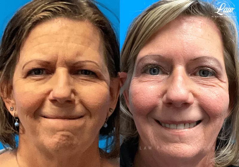 Brow Lift Before & After Photo. Surgery performed in Dallas, TX at Law Plastic Surgery.