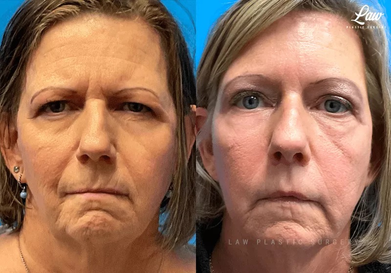 Brow Lift Before & After Photo. Surgery performed in Dallas, TX at Law Plastic Surgery.