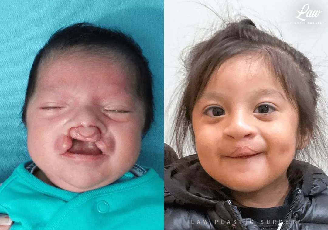 Cleft Lip Repair Before & After Photo. Surgery performed in Dallas, TX at Law Plastic Surgery.