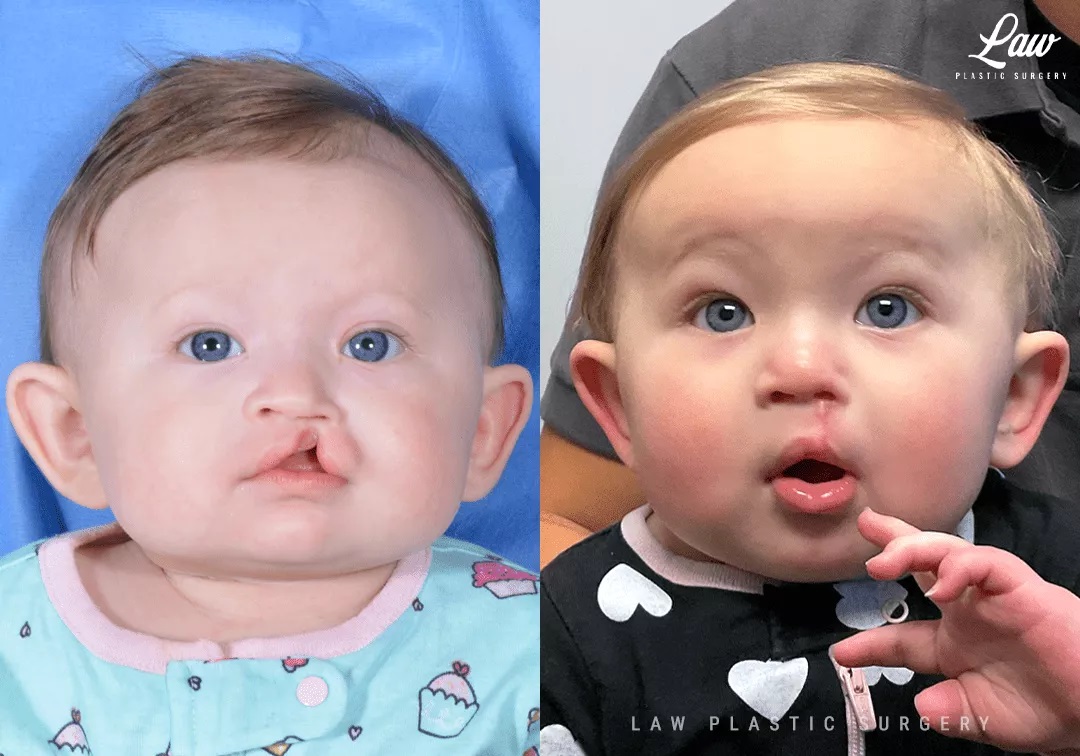 Cleft Lip Repair Before & After Photo. Surgery performed in Dallas, TX at Law Plastic Surgery.