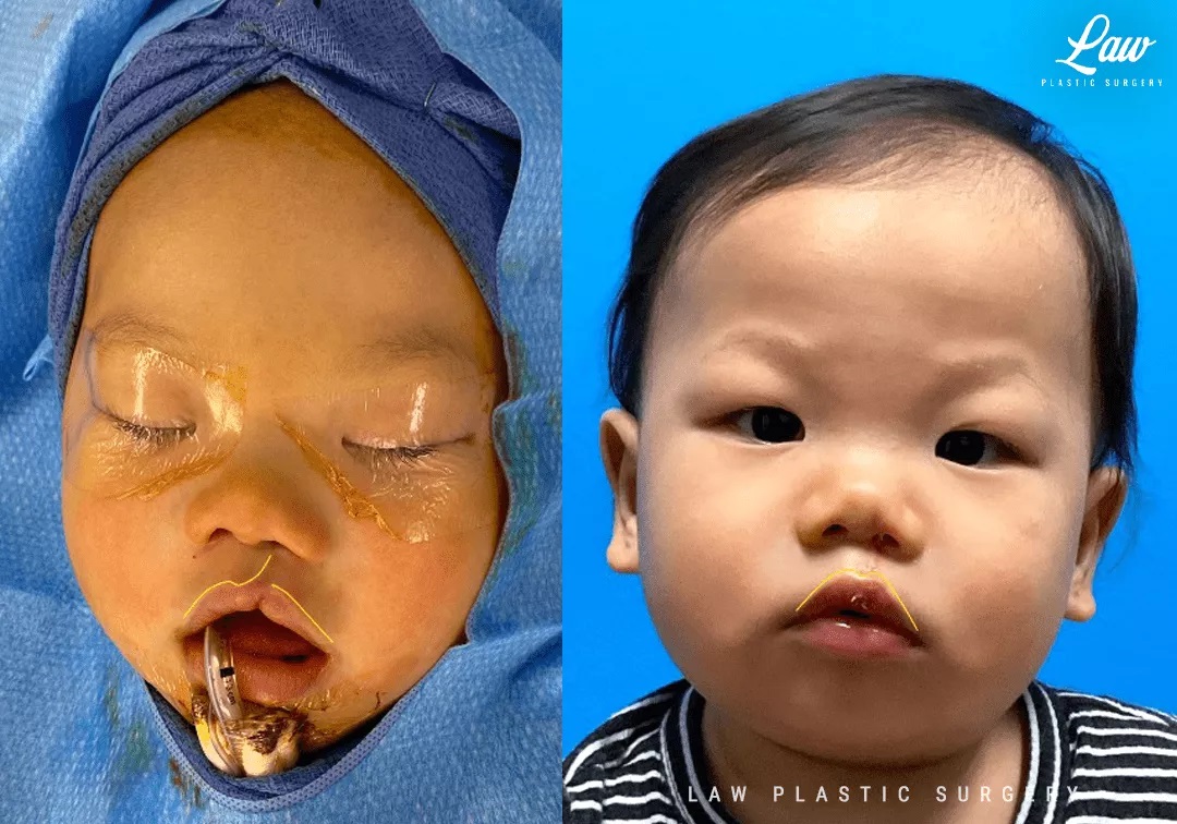 Cleft Lip Repair Before & After Photo. Surgery performed in Dallas, TX at Law Plastic Surgery.