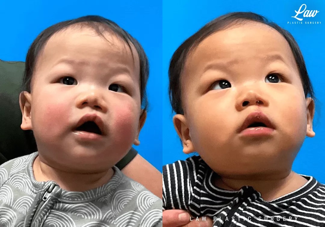 Cleft Lip Repair Before & After Photo. Surgery performed in Dallas, TX at Law Plastic Surgery.