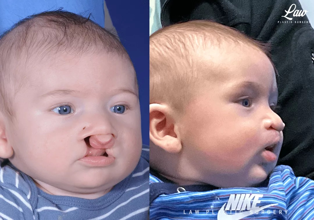 Cleft Lip Repair Before & After Photo. Surgery performed in Dallas, TX at Law Plastic Surgery.