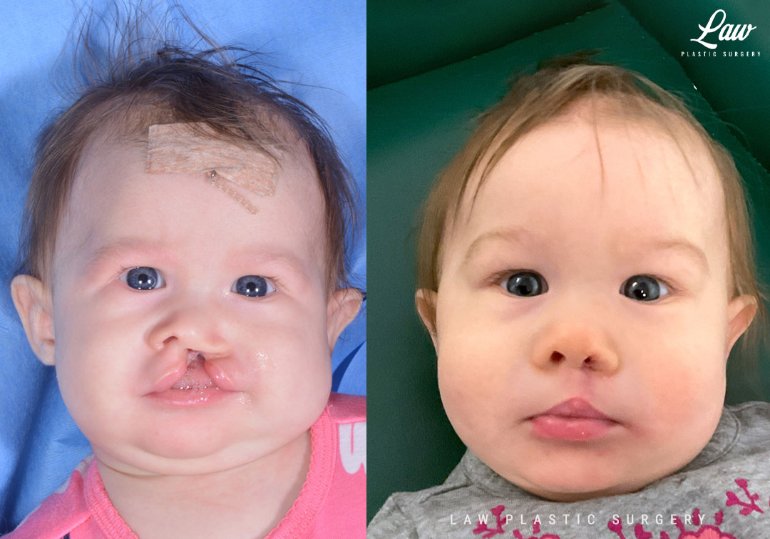 Cleft Lip Repair Before & After Photo. Surgery performed in Dallas, TX at Law Plastic Surgery.