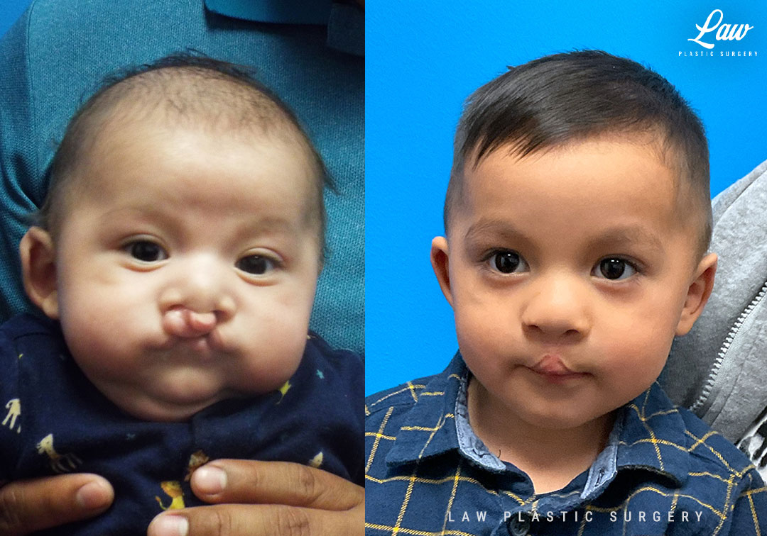 Cleft Lip Repair Before & After Photo. Surgery performed in Dallas, TX at Law Plastic Surgery.