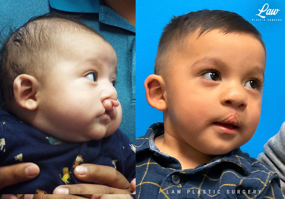 Cleft Lip Repair Before & After Photo. Surgery performed in Dallas, TX at Law Plastic Surgery.