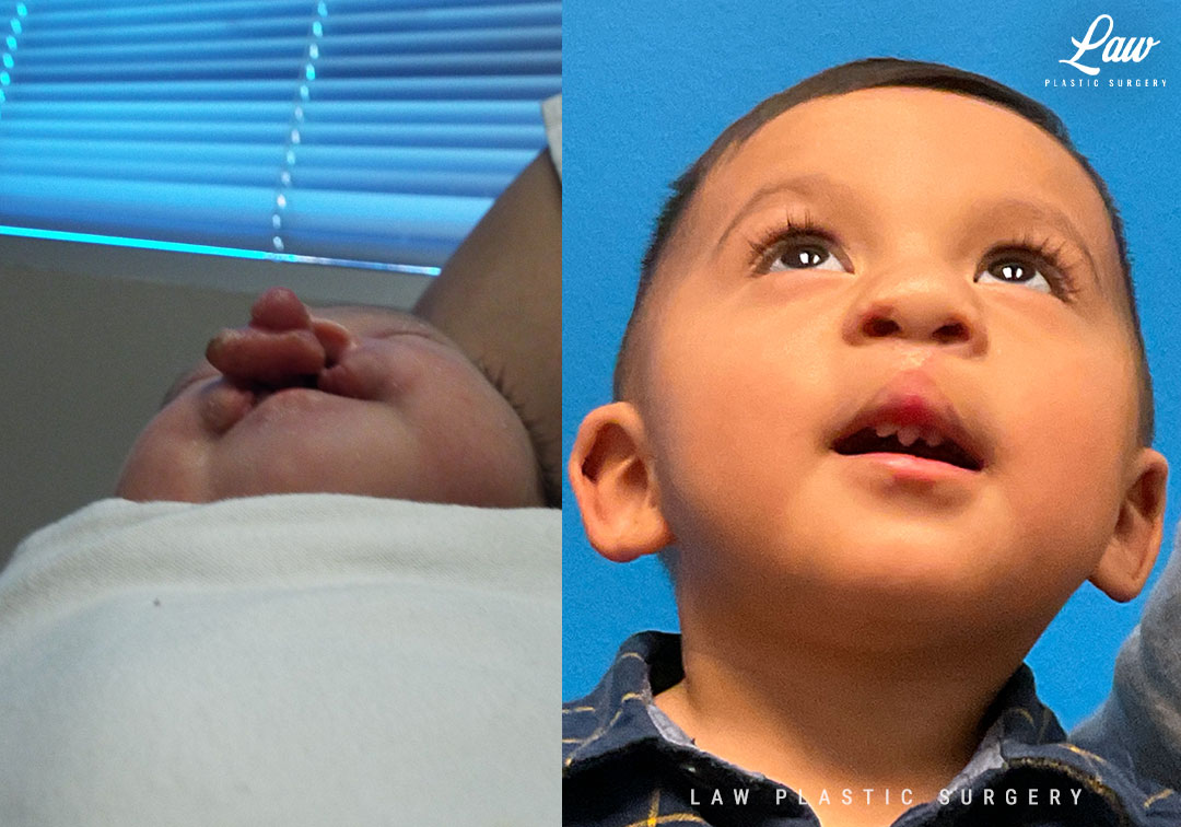 Cleft Lip Repair Before & After Photo. Surgery performed in Dallas, TX at Law Plastic Surgery.