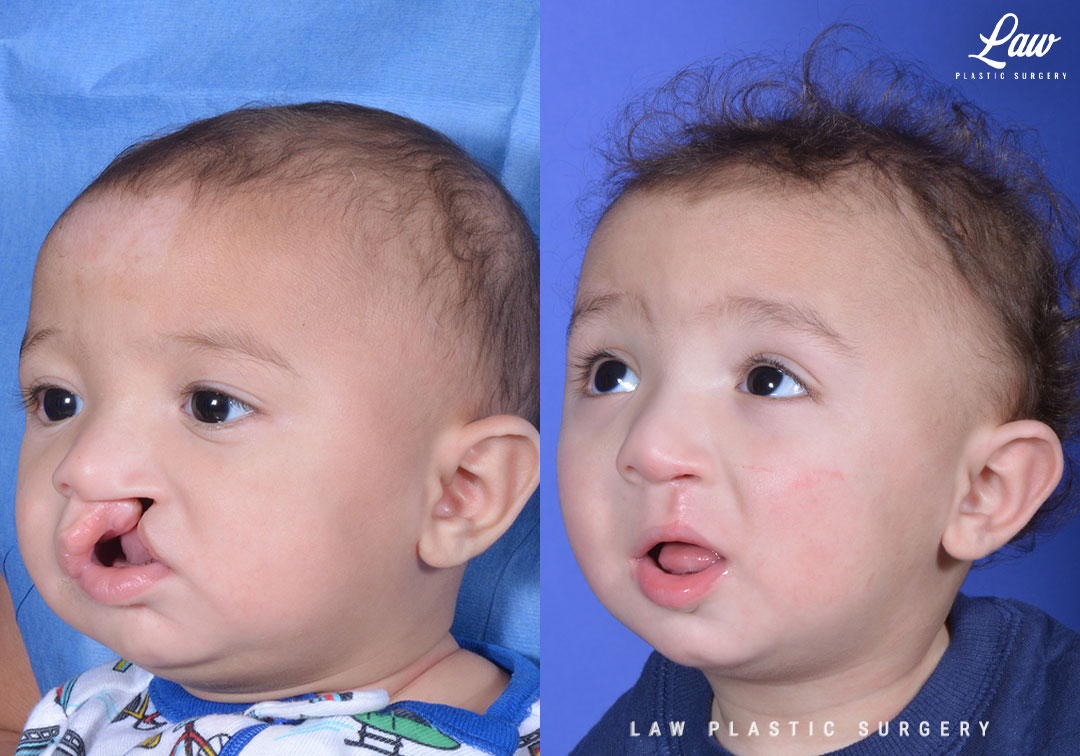 Cleft Lip Repair Before & After Photo. Surgery performed in Dallas, TX at Law Plastic Surgery.