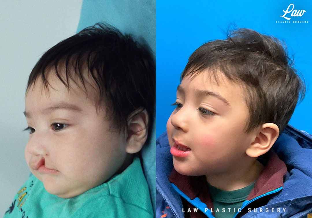 Cleft Lip Repair Before & After Photo. Surgery performed in Dallas, TX at Law Plastic Surgery.