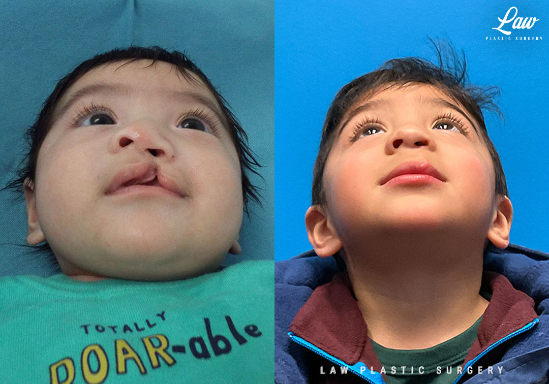 Cleft Lip Repair Before & After Photo. Surgery performed in Dallas, TX at Law Plastic Surgery.