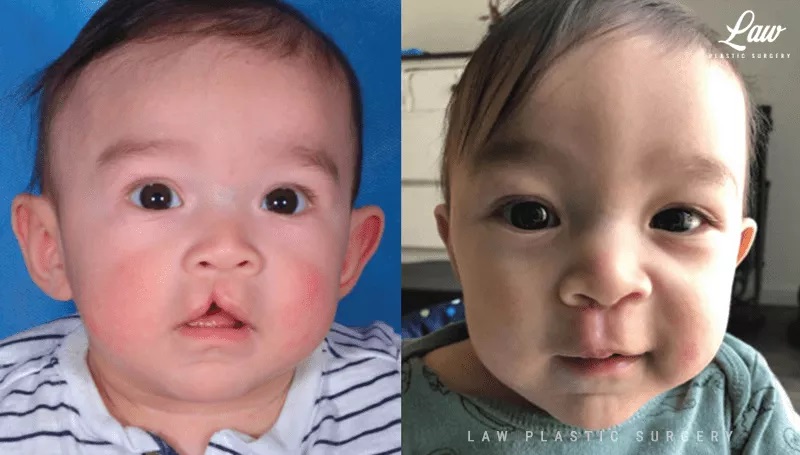 Cleft Lip Repair Before & After Photo. Surgery performed in Dallas, TX at Law Plastic Surgery.