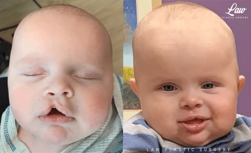 Cleft Lip Repair Before & After Photo. Surgery performed in Dallas, TX at Law Plastic Surgery.