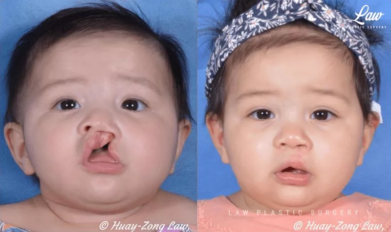 Cleft Lip Repair Before & After Photo. Surgery performed in Dallas, TX at Law Plastic Surgery.
