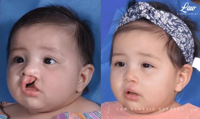Cleft Lip Repair Before & After Photo. Surgery performed in Dallas, TX at Law Plastic Surgery.