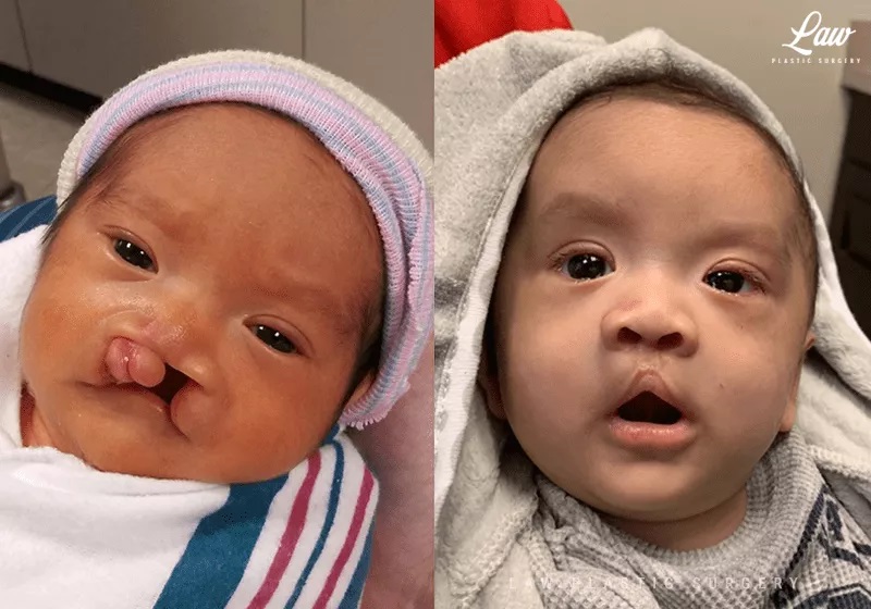 Cleft Lip Repair Primary Bilateral Before And After Photos Law Plastic Surgery