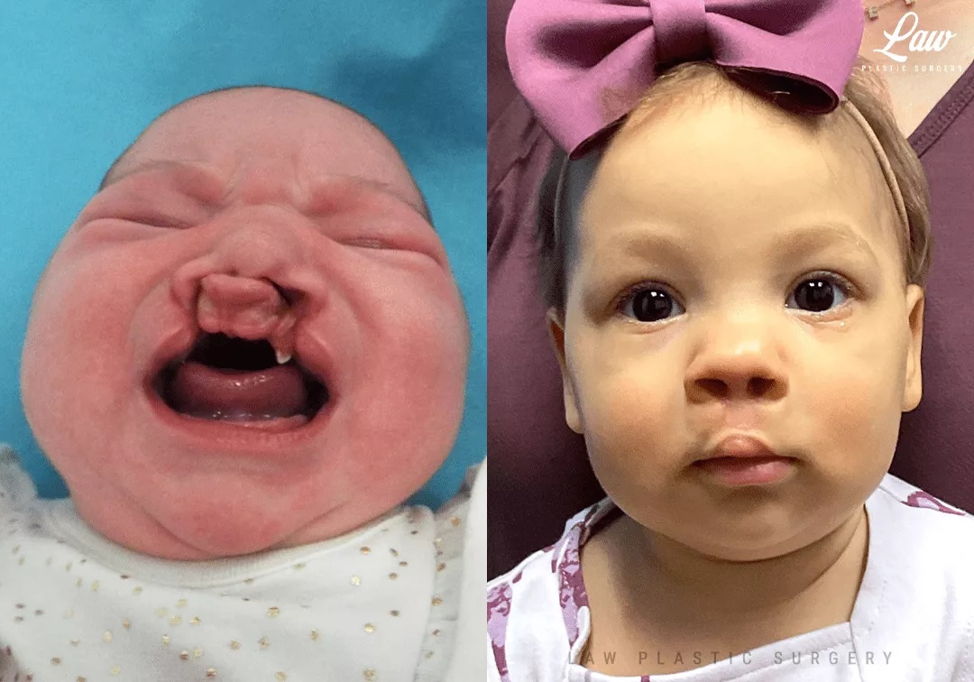 Cleft Lip Repair, Primary Bilateral Before and After Photo. Surgery performed in Dallas, TX at Law Plastic Surgery.