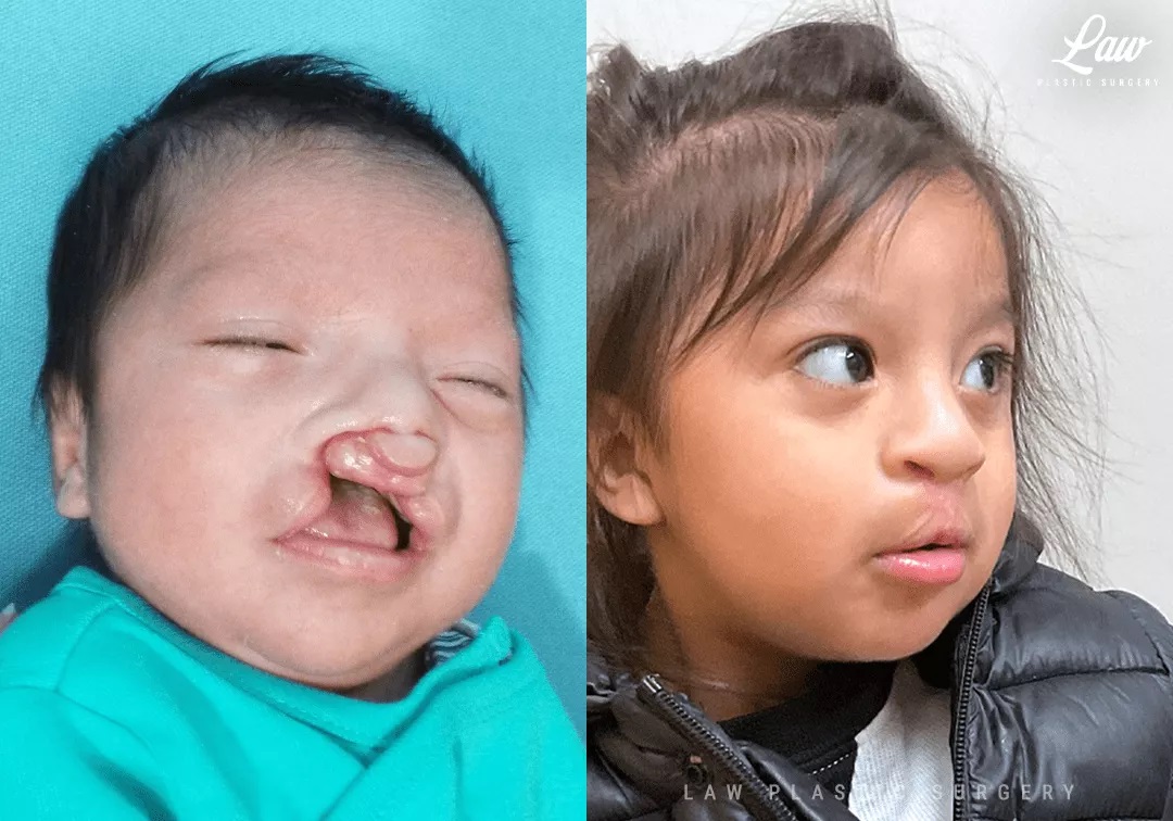 Cleft Lip Repair, Primary Bilateral Before and After Photo. Surgery performed in Dallas, TX at Law Plastic Surgery.