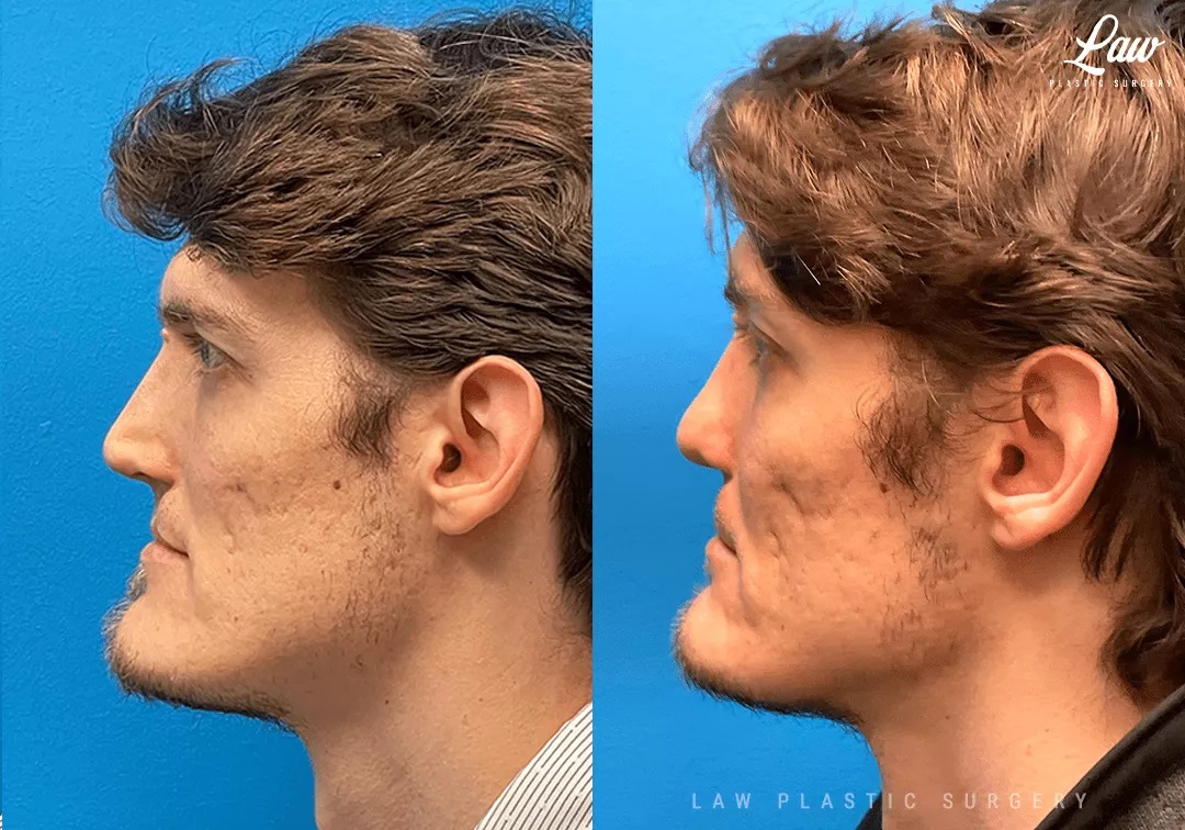 Cleft Rhinoplasty (Cleft Nose Surgery) Before & After Photo. Surgery performed in Dallas, TX at Law Plastic Surgery.