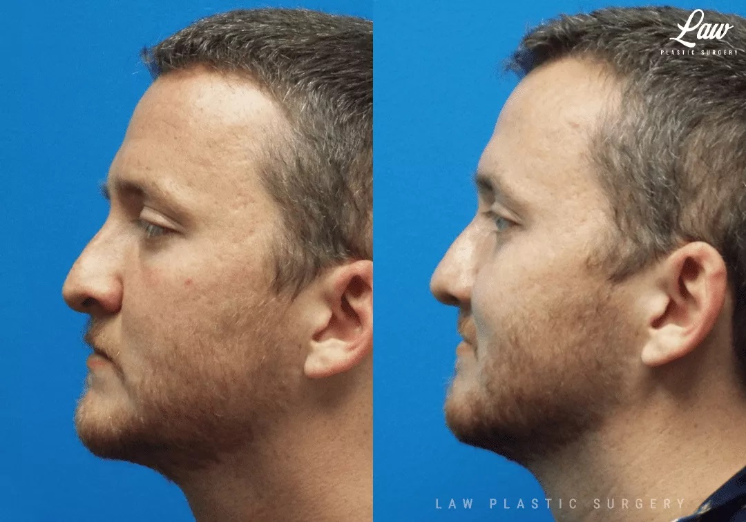 Cleft Rhinoplasty (Cleft Nose Surgery) Before & After Photo. Surgery performed in Dallas, TX at Law Plastic Surgery.