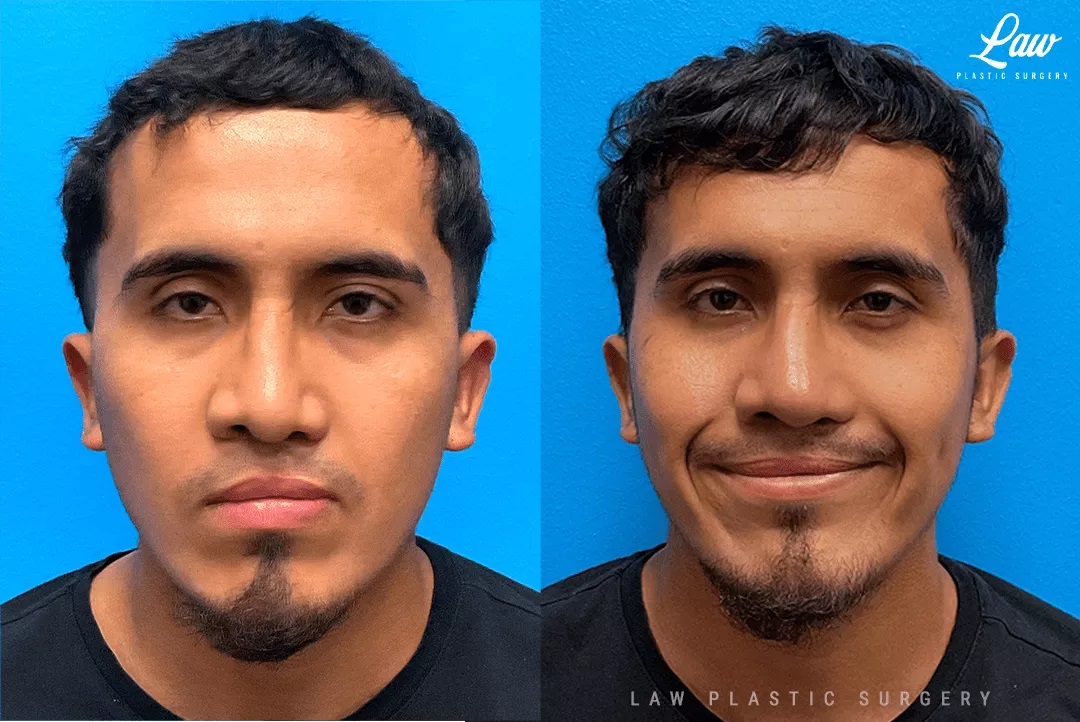 Cleft Rhinoplasty (Cleft Nose Surgery) Before & After Photo. Surgery performed in Dallas, TX at Law Plastic Surgery.