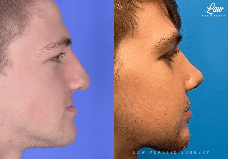 Cleft Rhinoplasty (Cleft Nose Surgery) Before & After Photo. Surgery performed in Dallas, TX at Law Plastic Surgery.