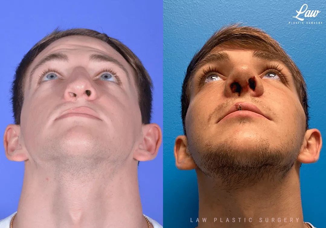 Cleft Rhinoplasty (Cleft Nose Surgery) Before & After Photo. Surgery performed in Dallas, TX at Law Plastic Surgery.