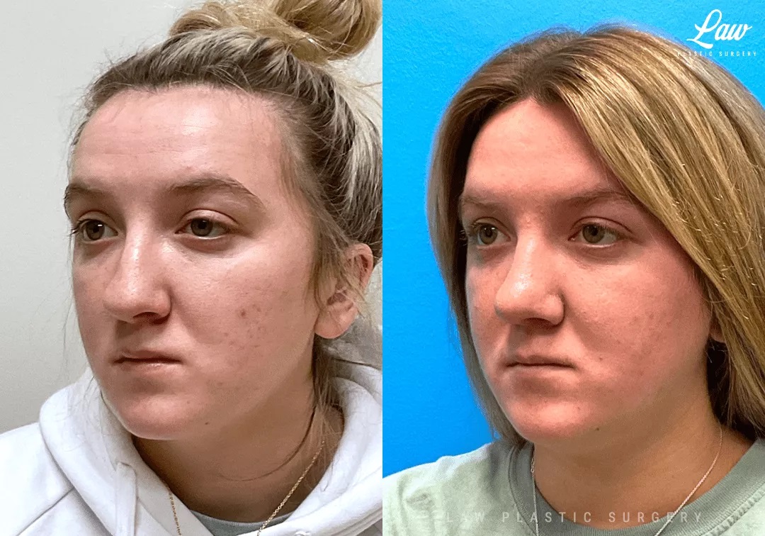 Cleft Rhinoplasty (Cleft Nose Surgery) Before & After Photo. Surgery performed in Dallas, TX at Law Plastic Surgery.