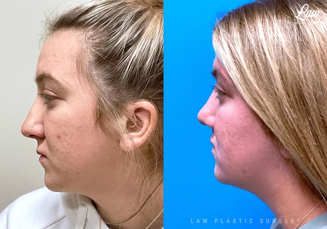 Cleft Rhinoplasty (Cleft Nose Surgery) Before & After Photo. Surgery performed in Dallas, TX at Law Plastic Surgery.