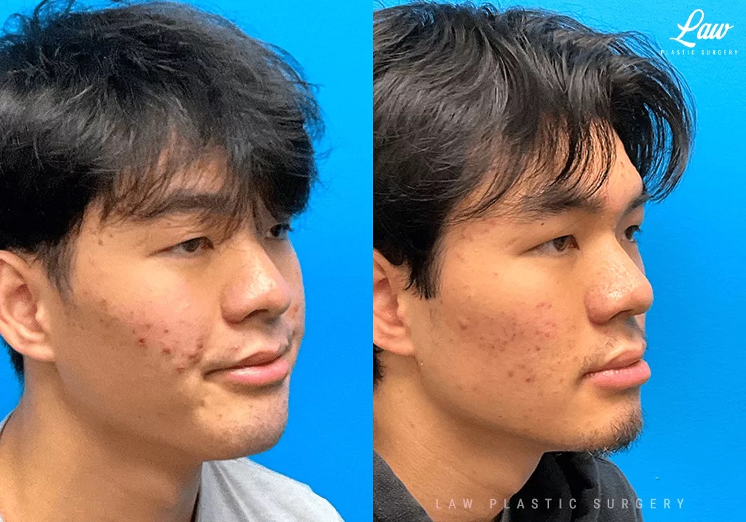 Cleft Rhinoplasty (Cleft Nose Surgery) Before & After Photo. Surgery performed in Dallas, TX at Law Plastic Surgery.