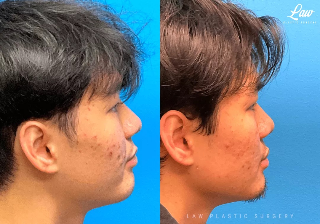 Cleft Rhinoplasty (Cleft Nose Surgery) Before & After Photo. Surgery performed in Dallas, TX at Law Plastic Surgery.