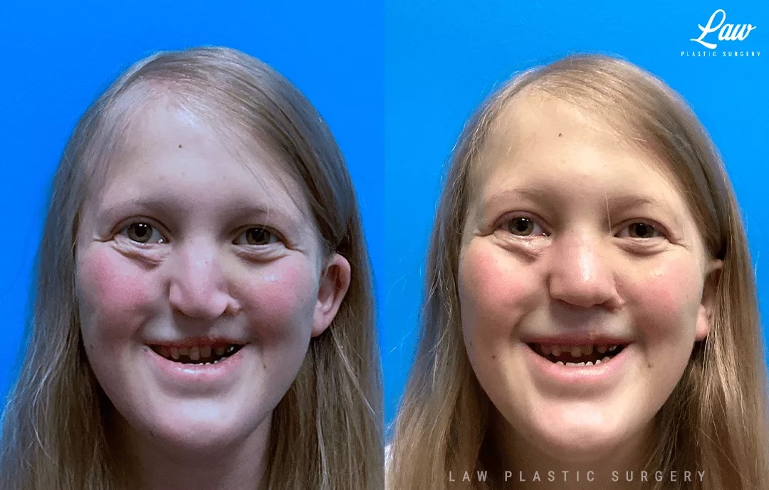 Cleft Rhinoplasty (Cleft Nose Surgery) Before & After Photo. Surgery performed in Dallas, TX at Law Plastic Surgery.