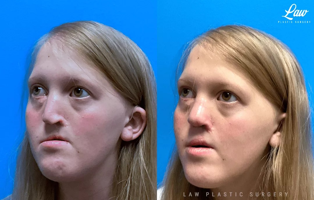 Cleft Rhinoplasty (Cleft Nose Surgery) Before & After Photo. Surgery performed in Dallas, TX at Law Plastic Surgery.