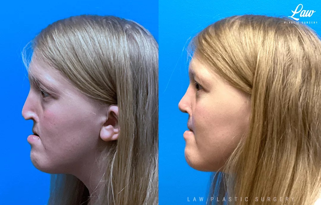 Cleft Rhinoplasty (Cleft Nose Surgery) Before & After Photo. Surgery performed in Dallas, TX at Law Plastic Surgery.