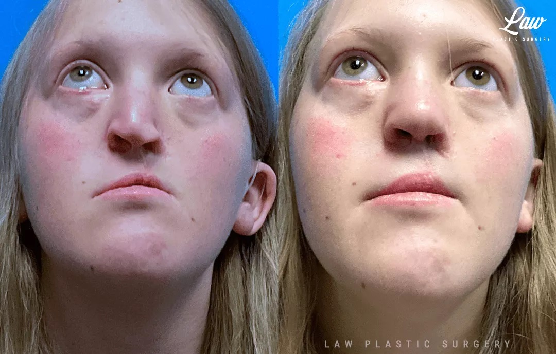 Cleft Rhinoplasty (Cleft Nose Surgery) Before & After Photo. Surgery performed in Dallas, TX at Law Plastic Surgery.