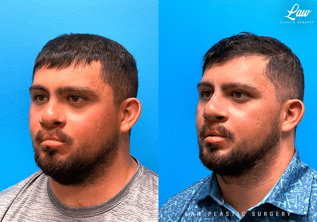 Cleft Rhinoplasty (Cleft Nose Surgery) Before & After Photo. Surgery performed in Dallas, TX at Law Plastic Surgery.
