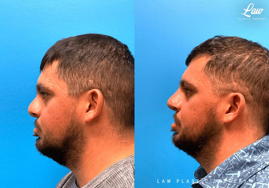 Cleft Rhinoplasty (Cleft Nose Surgery) Before & After Photo. Surgery performed in Dallas, TX at Law Plastic Surgery.