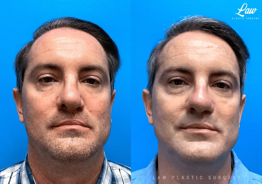 Cleft Rhinoplasty (Cleft Nose Surgery) Before & After Photo. Surgery performed in Dallas, TX at Law Plastic Surgery.