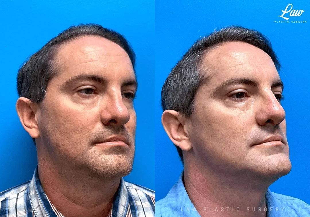 Cleft Rhinoplasty (Cleft Nose Surgery) Before & After Photo. Surgery performed in Dallas, TX at Law Plastic Surgery.