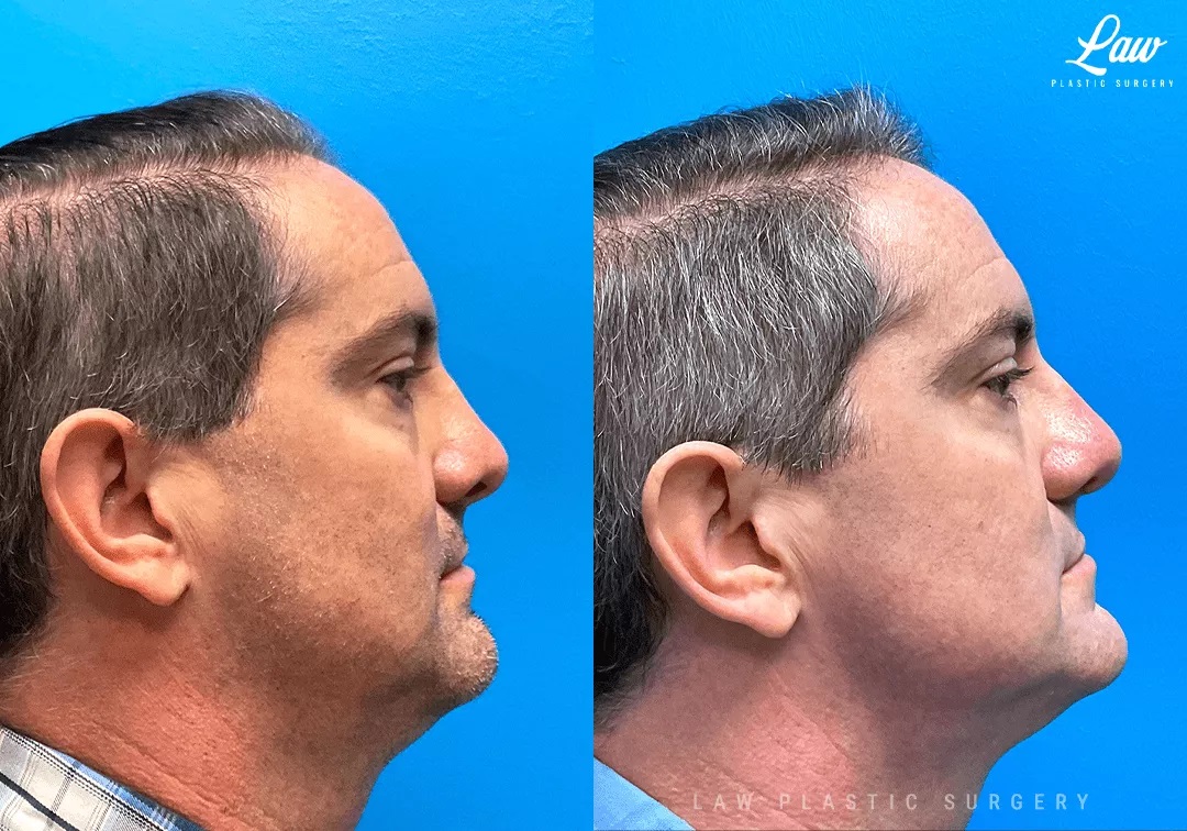 Cleft Rhinoplasty (Cleft Nose Surgery) Before & After Photo. Surgery performed in Dallas, TX at Law Plastic Surgery.