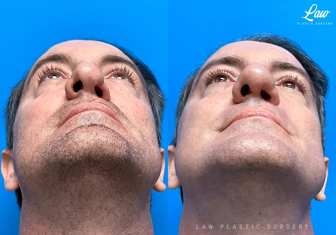 Cleft Rhinoplasty (Cleft Nose Surgery) Before & After Photo. Surgery performed in Dallas, TX at Law Plastic Surgery.