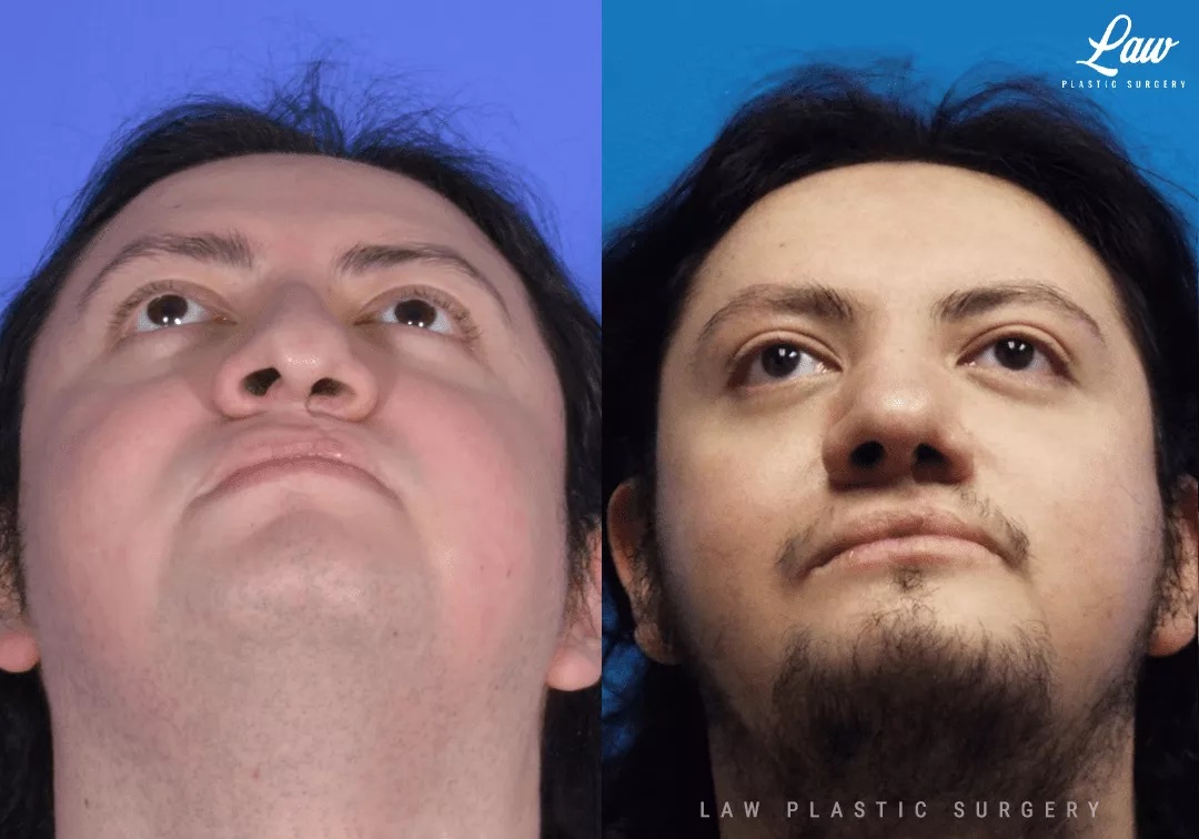 Cleft Rhinoplasty (Cleft Nose Surgery) Before & After Photo. Surgery performed in Dallas, TX at Law Plastic Surgery.