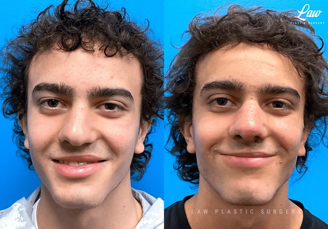 Cleft Rhinoplasty (Cleft Nose Surgery) Before & After Photo. Surgery performed in Dallas, TX at Law Plastic Surgery.