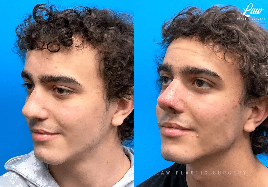 Cleft Rhinoplasty (Cleft Nose Surgery) Before & After Photo. Surgery performed in Dallas, TX at Law Plastic Surgery.