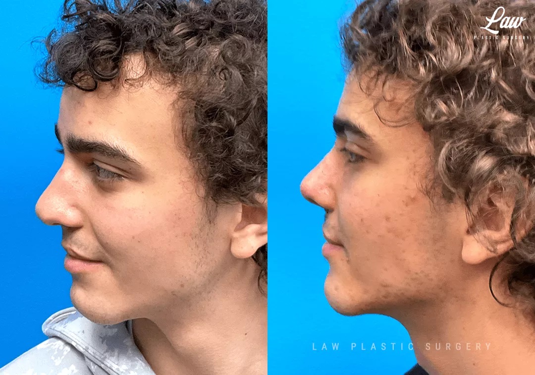 Cleft Rhinoplasty (Cleft Nose Surgery) Before & After Photo. Surgery performed in Dallas, TX at Law Plastic Surgery.