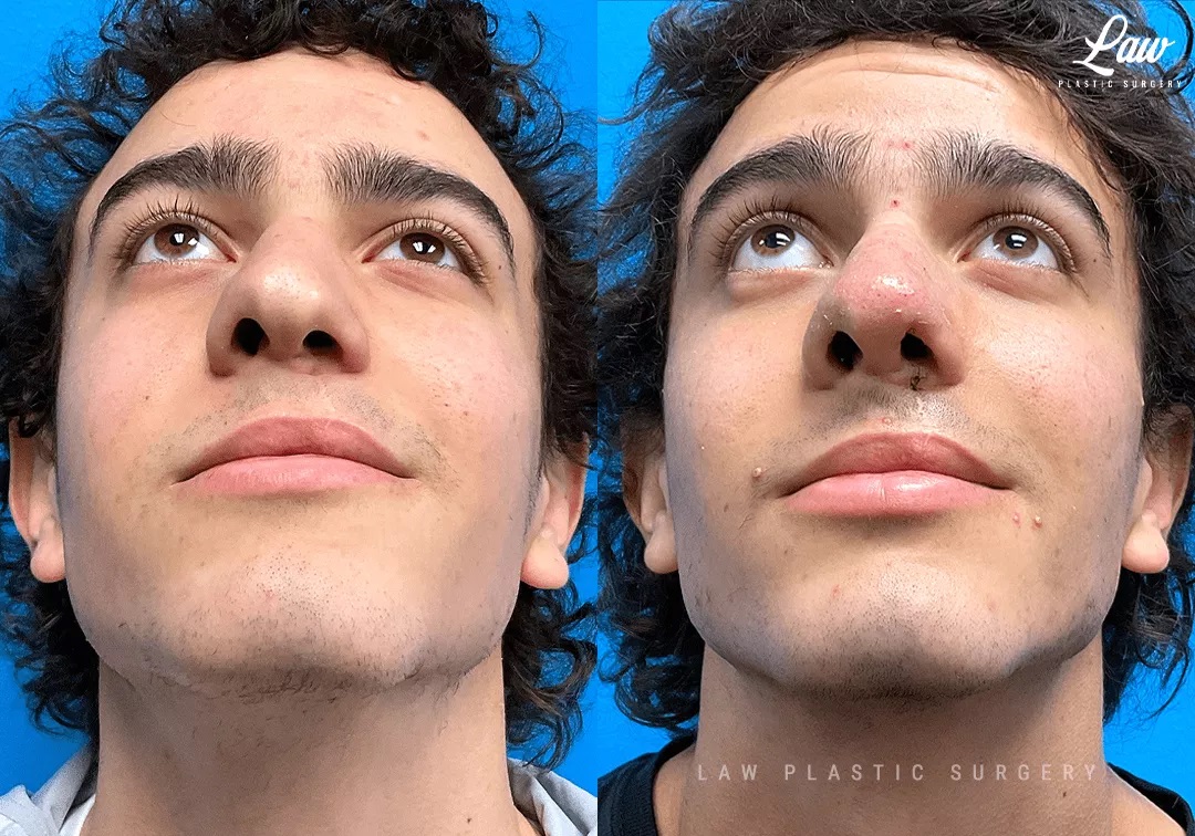 Cleft Rhinoplasty (Cleft Nose Surgery) Before & After Photo. Surgery performed in Dallas, TX at Law Plastic Surgery.